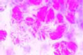 Mycobacterium leprae, causing leprosy slide