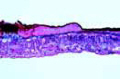 Rhytisma acerinum slide, tar-spot of maple