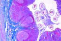 Enterobius vermicularis, sec. through human appendix with parasites in situ