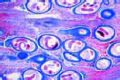 Trichinella spiralis, section of infected muscle with encysted larvae