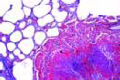 Miliary tuberculosis of lung slide