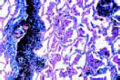 Anthracosis of lung