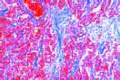 Chronic pneumonia slide