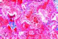 Hemorrhagic infarct of lung slide