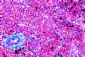 Malaria melanemia of spleen slide