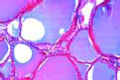 Goiter of thyroid gland, Struma colloides slide