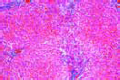 Parenchymatous and fatty degeneration of liver slide