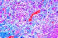 Metastasis of liver slide