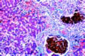 Icterus hepatis slide
