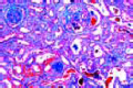 Chronic glomerulonephritis slide