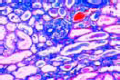 Amyloid degeneration of kidney slide