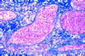 Gumma of testicle slide