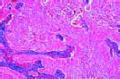 Carcinoma cervicis uteri slide
