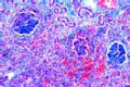 Septic embolic nephritis slide