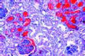 Acute hemorrhagic nephritis slide