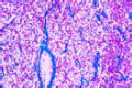 Sarcoma of testicle slide