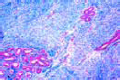 Fibroadenoma of breast slide