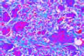 Giant cell sarcoma of maxilla slide