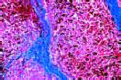 Melanosarcoma of skin slide