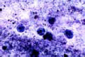 Entamoeba histolytica, causes amebic dysentery