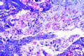Entamoeba histolytica slide, section through diseased colon