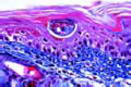 Schistosoma mansoni, ova in section of liver